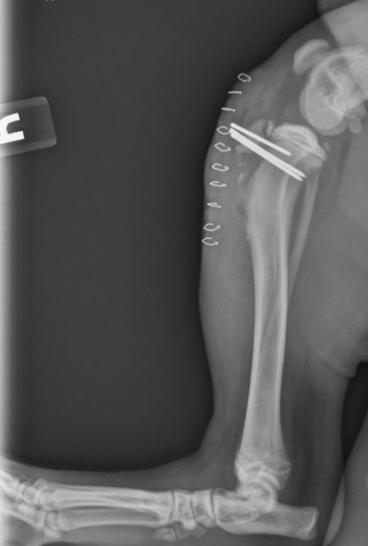 Tibial Crest Avulsion Archives | Dr Phil Zeltzman’s Blog