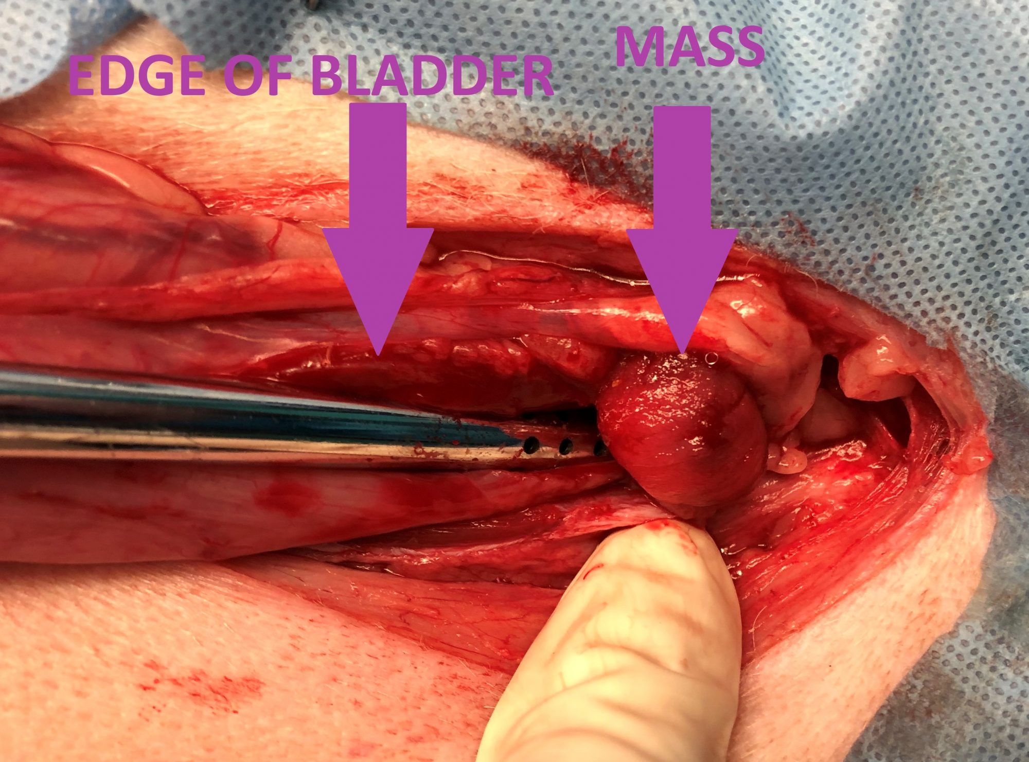 A mass blocking the bladder