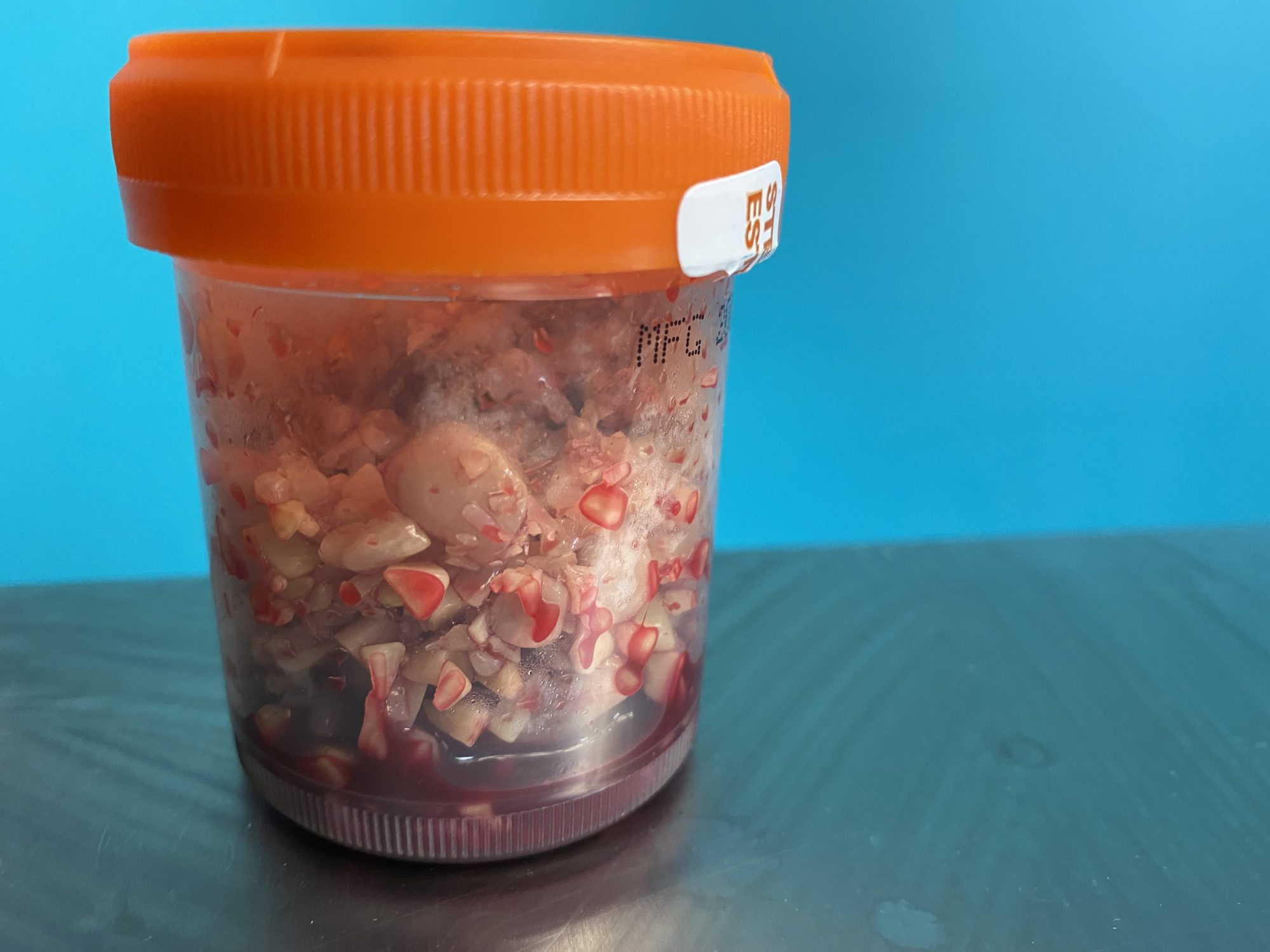 Bladder stones